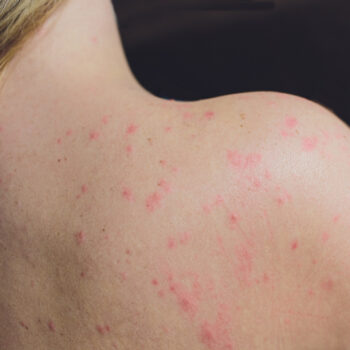 Skin Rashes described and treatments at Chicago's Nima Skin Institute