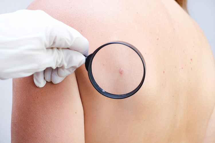 Dr. examining new growth on your skin and determining if it's a skin tag, wart, or mole.