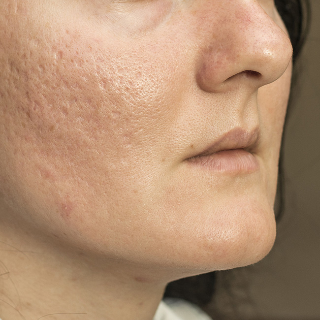 Acne scars — ways to reduce them at Chicago's Nima Skin Institute