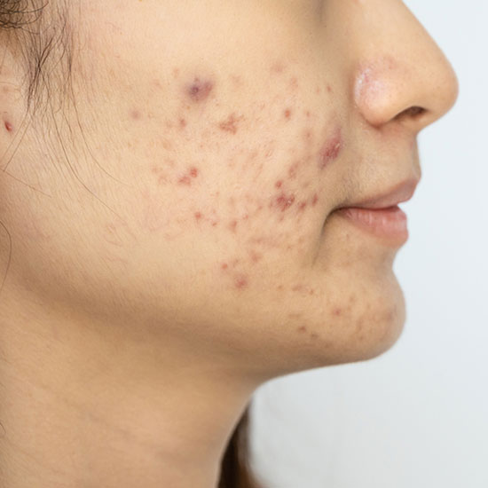 Acne treatment triggers and treatments available at Chicago Nima Skin Institute